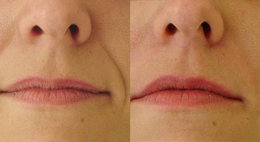 Контурная пластика лица: коррекция носогубных складок и формы губ.